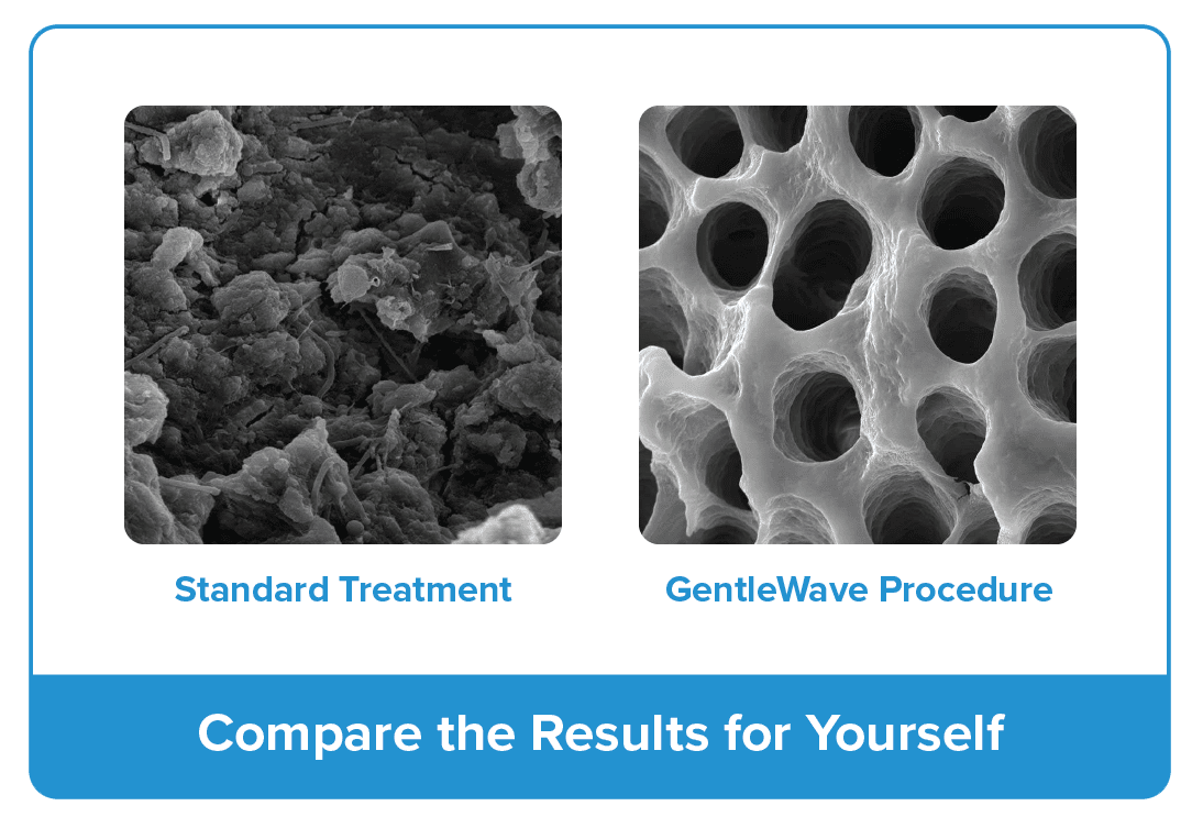 Image showing comparison between standard treatment and Gentle Wave Procedure